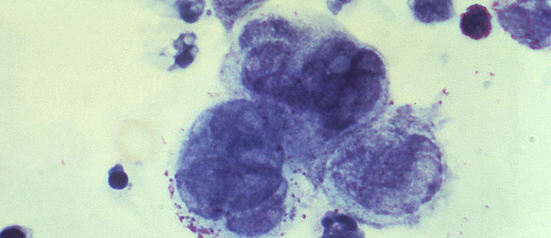 Herpes multinucleated giant cells